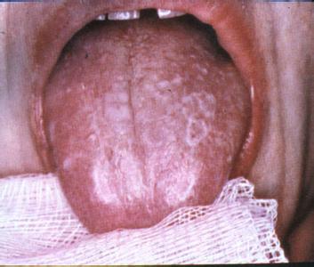 口腔扁平苔藓的症状有哪些